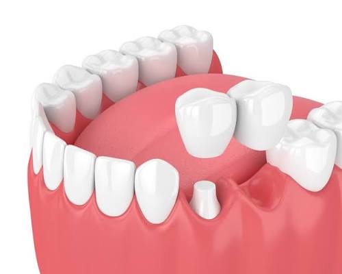 What Happens If You Lose a Tooth and Don’t Replace It?