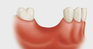 How Does Tooth Loss Affect the Jawbone