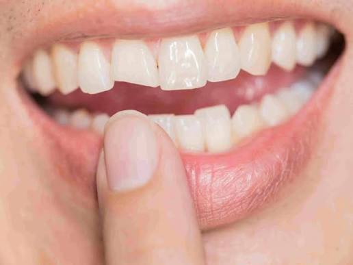 Does Losing a Single Tooth Affect the Rest of Your Teeth? 