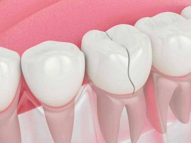 Can You Delay Replacing a Missing Tooth