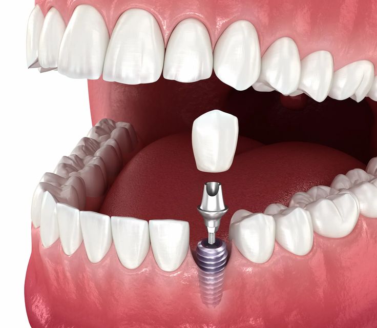 Dental implants in Turkey