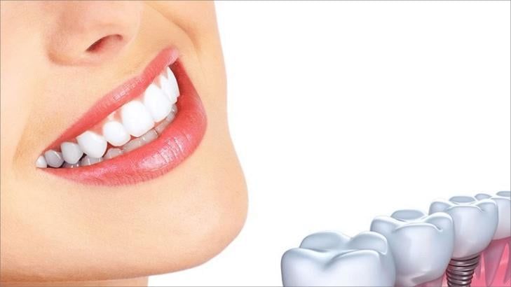 Is Everyone a Candidate for Dental Implants?