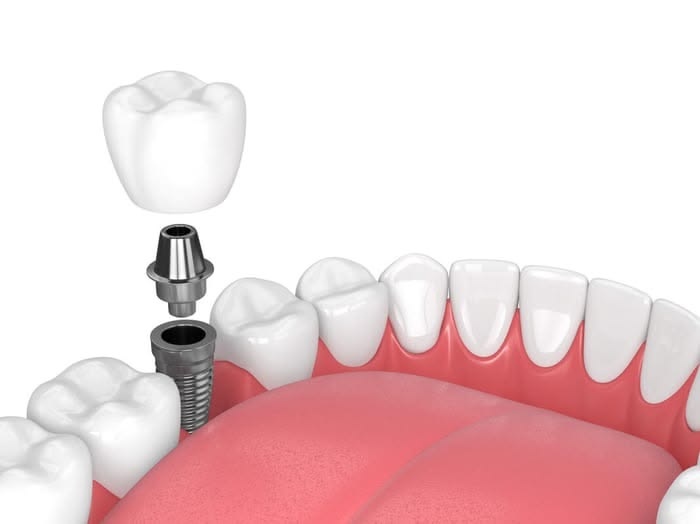 What Tests Are Required Before Dental Implants?
