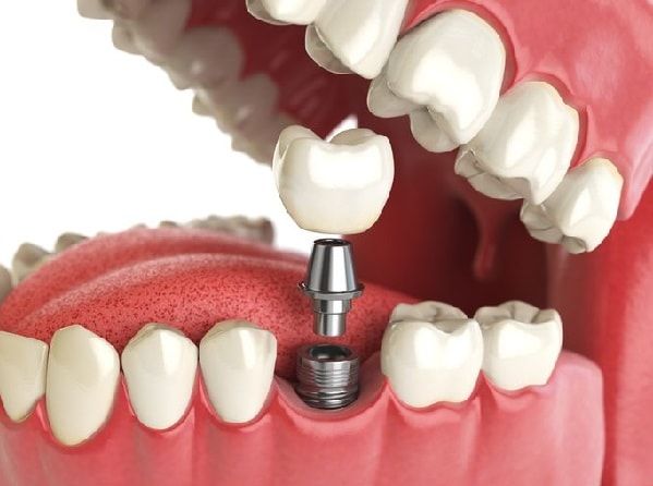 Dental Implant Lifespan