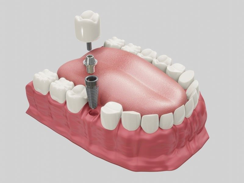 Dental Implant Success Rate