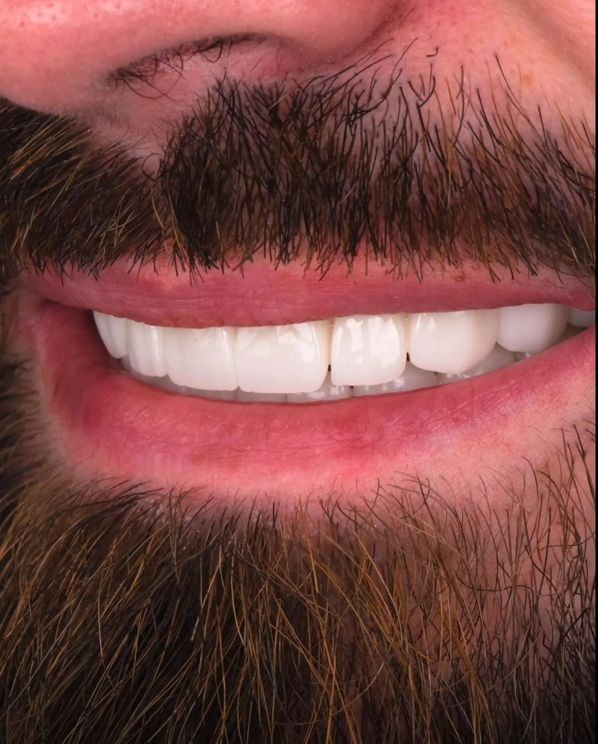 Dental Implants for Diabetic Patients