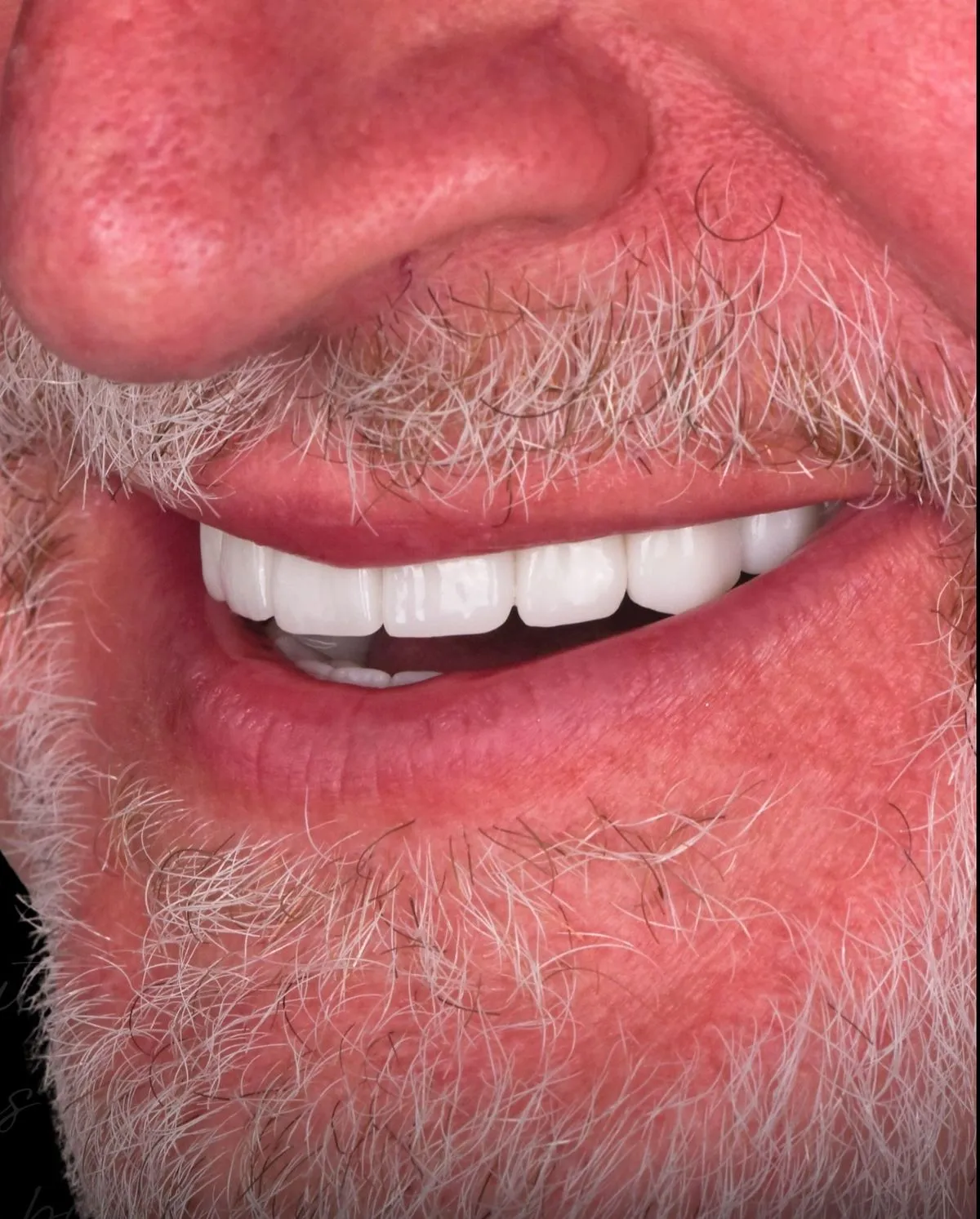 Bone grafting before dental implant